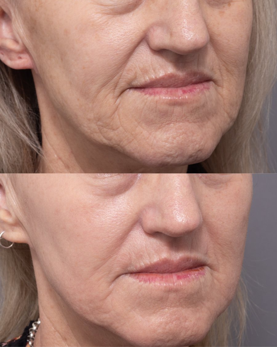 Etched lines of the lower face before and after fully ablative CO2 resurfacing