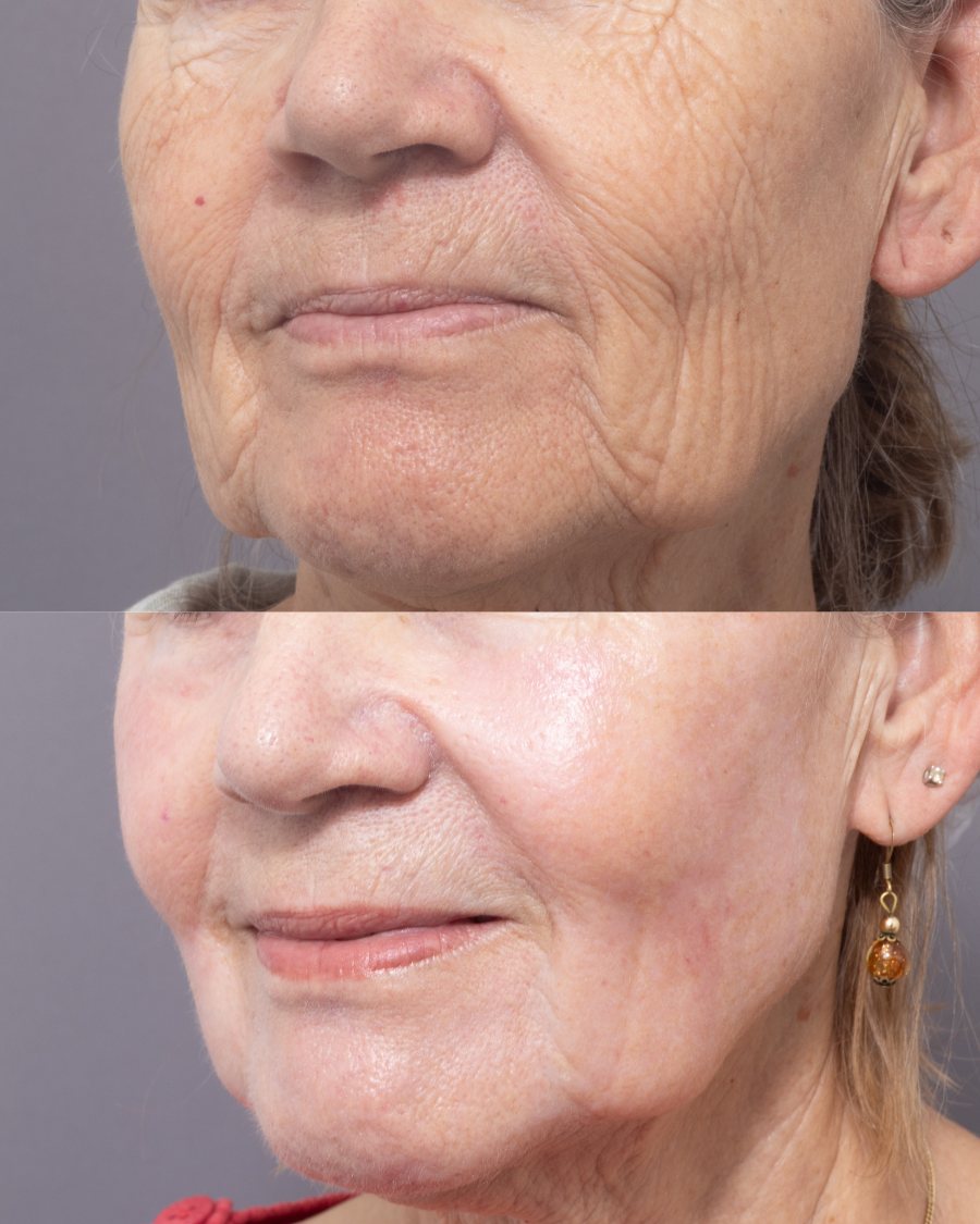 Wrinkles and laxity of the cheek and mouth before and after fully ablative CO2 resurfacing