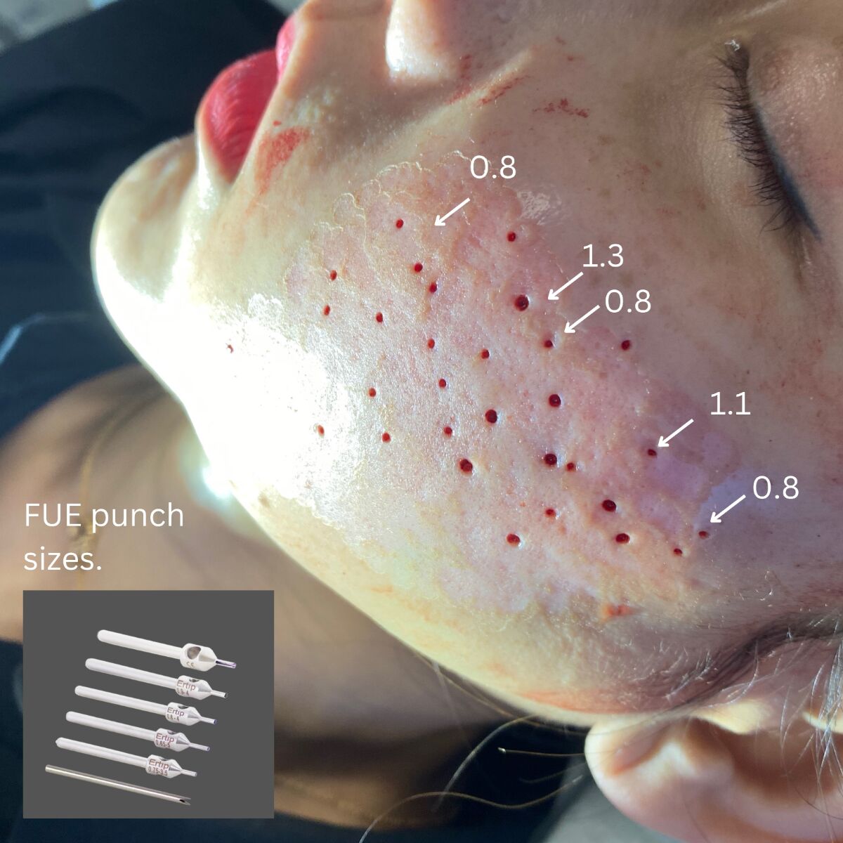 Cheek immediately after FUE punch excision of ice pick scars, with punch sizes of 0.8, 1.1 and 1.3 mm marked, and a row of FUE punches