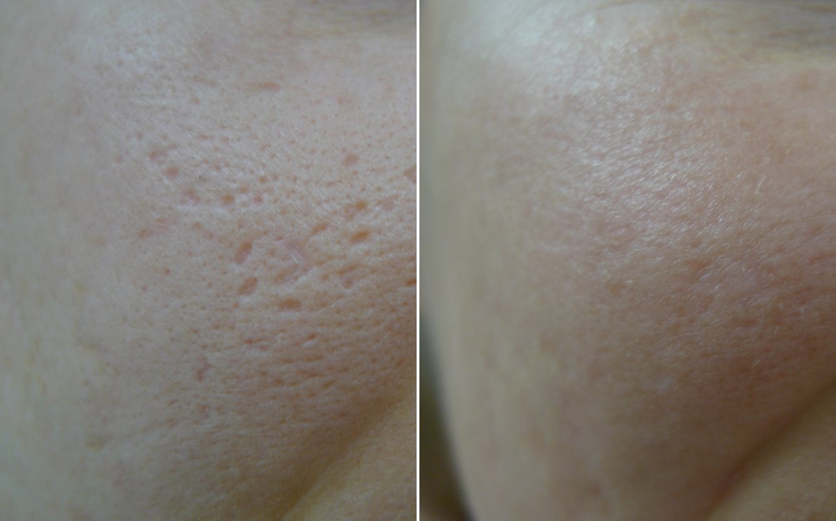Boxcar scars on the cheek before and after TCA CROSS