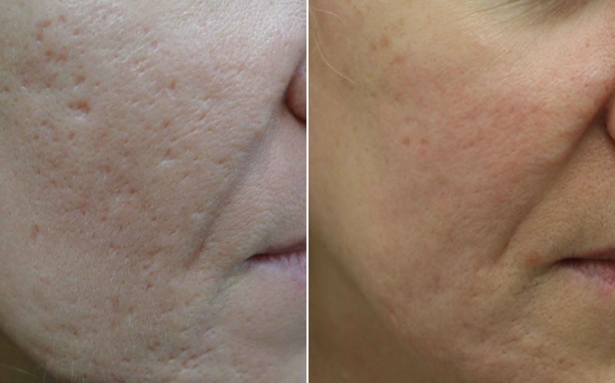 Acne scarring on the cheek before and after TCA CROSS