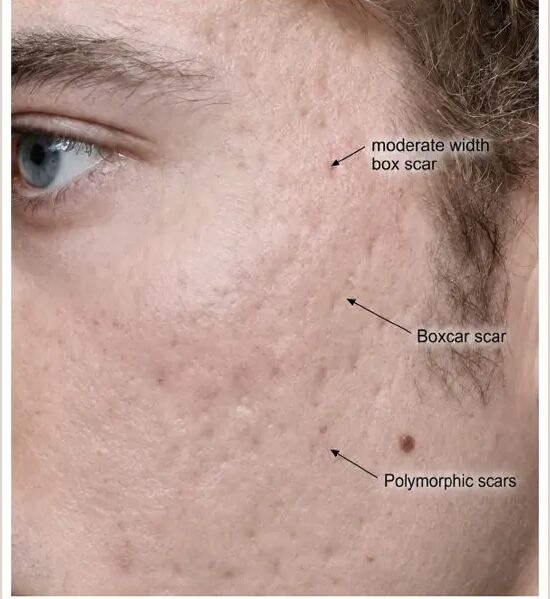 Cheek with acne scarring, showing ice pick, boxcar and polymorphic scars labelled side by side